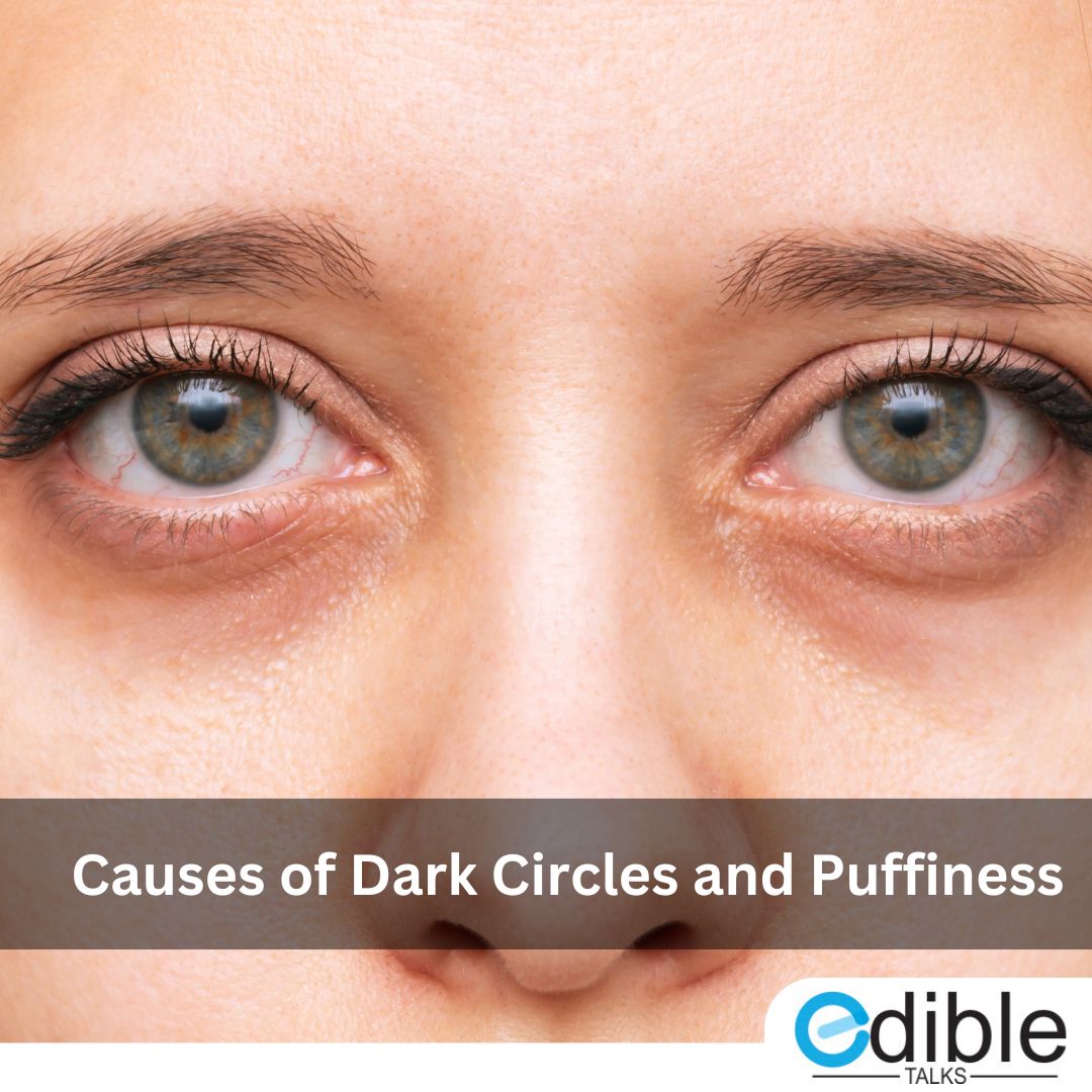 Causes of Dark Circles and Puffiness